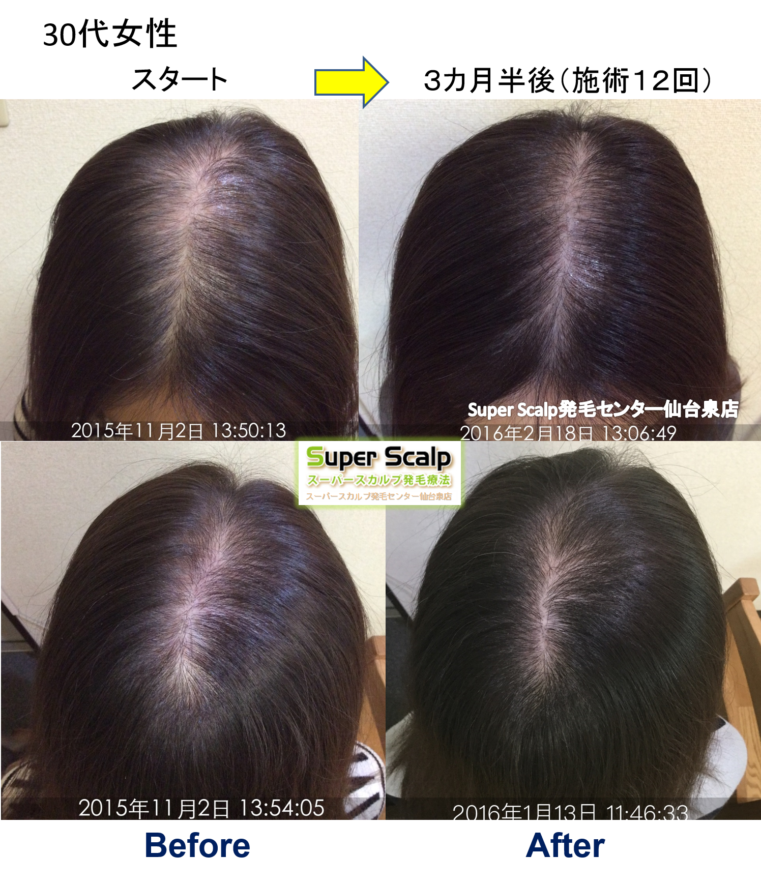 人工甘味料で薄毛に！？仙台市30代女性発毛実績。「頭皮の状態を毎回確認できて、少しずつ改善していることに満足しています。」 仙台で薄毛