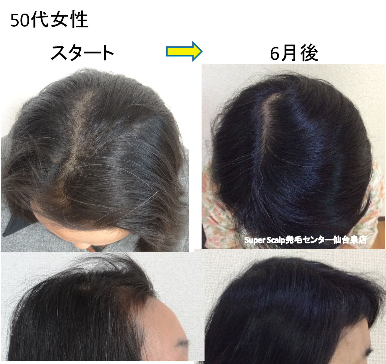 大崎市女性 病院でもなおらなかった円形脱毛が2ヶ月で改善