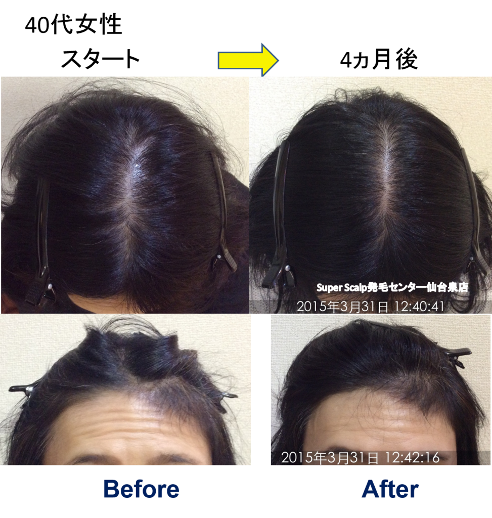 仙台市40代女性 4ヶ月で薄毛改善 頭頂部にも髪の毛が生えてきてうれしいです