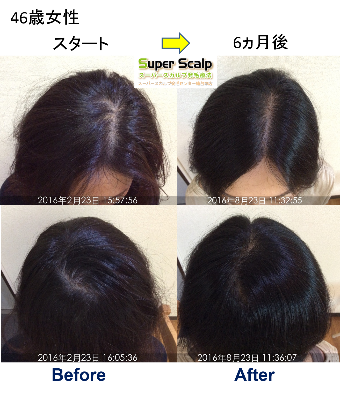 美容室の白髪染めによる薄毛が5ヶ月で改善仙台40代女性発毛実績
