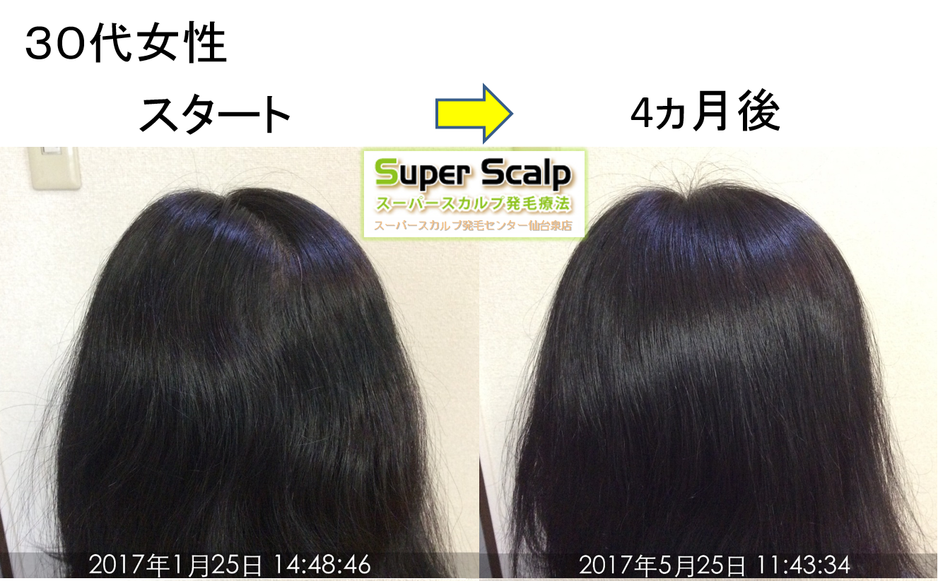 仙台30代女性4ヶ月で薄毛改善！ボリュームアップを実感！！恐怖の白髪染め頭皮ダメージ【画像】