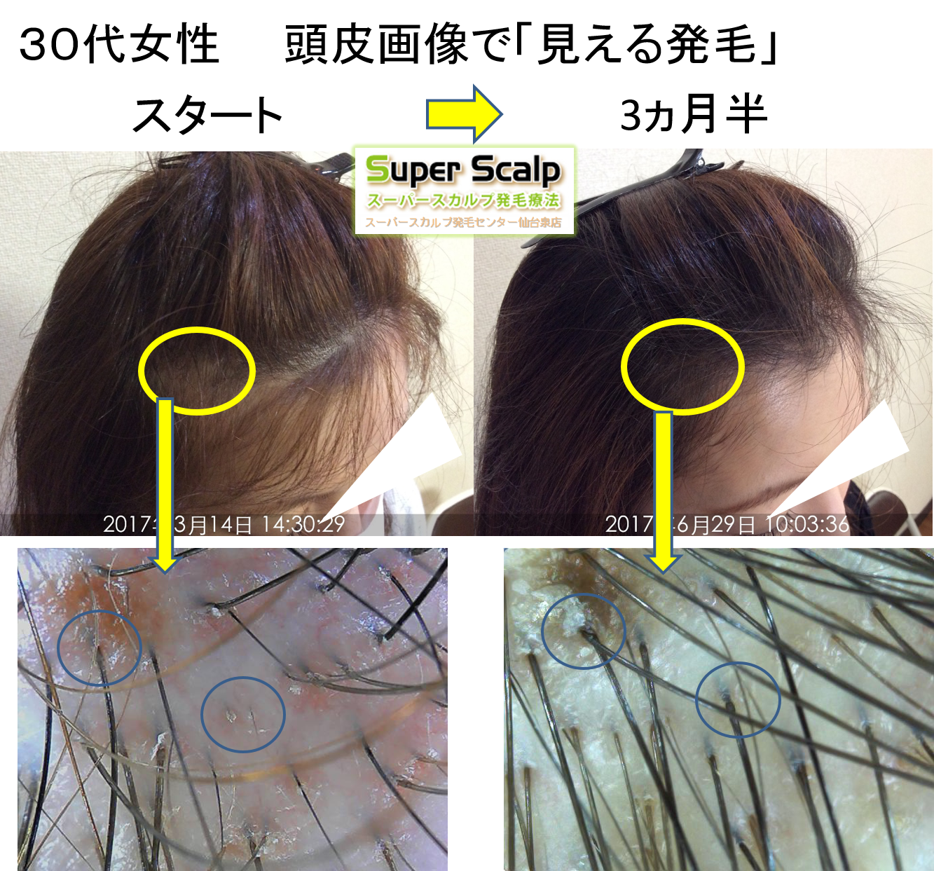 New症例！30代女性の薄毛が改善！当店は同じ毛穴ひとつレベルで改善経過を確認します。