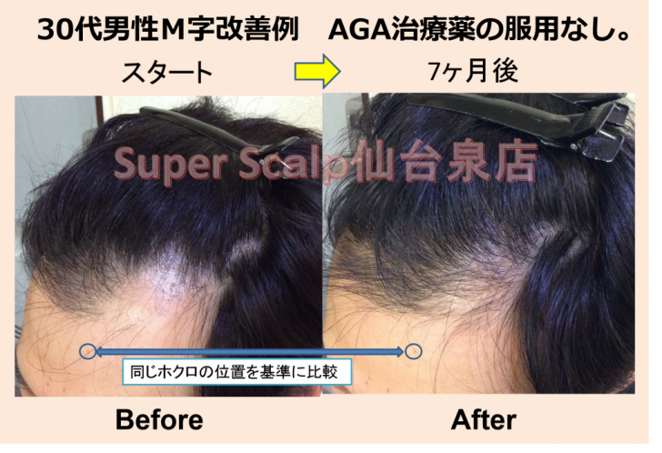 病院のAGA薄毛治療はすでに時代遅れ！？仙台市30代男性くすりを飲まずに4ヶ月で劇的薄毛改善。 仙台で薄毛AGA対策！女性男性の薄毛