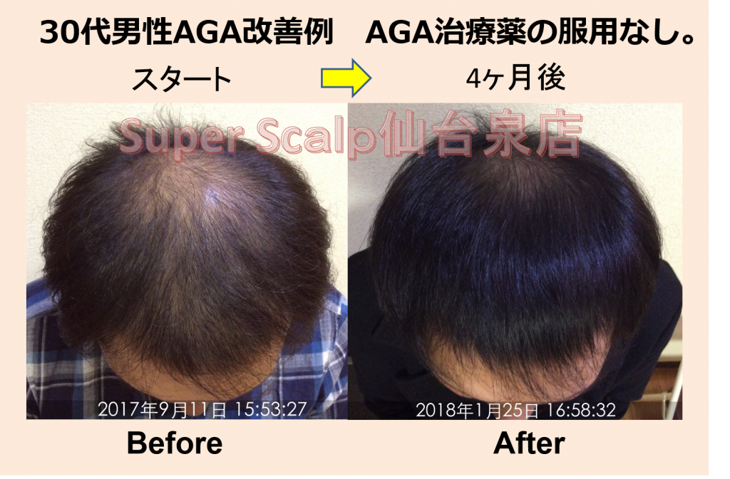 病院のAGA薄毛治療はすでに時代遅れ！？仙台市30代男性くすりを飲まずに4ヶ月で劇的薄毛改善。