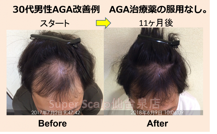 仙台で薬を飲まないAGA治療ならお任せ。30代男性の発毛症例ご紹介。