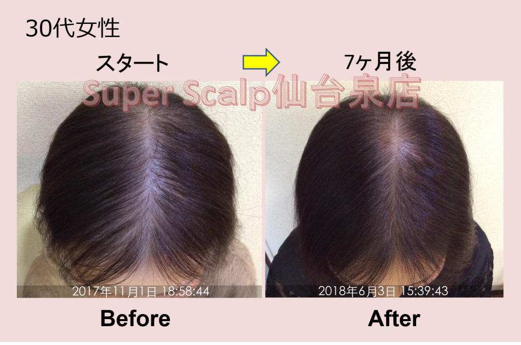 重度のびまん性脱毛症が7カ月で改善。30代女性の発毛症例をご紹介します。