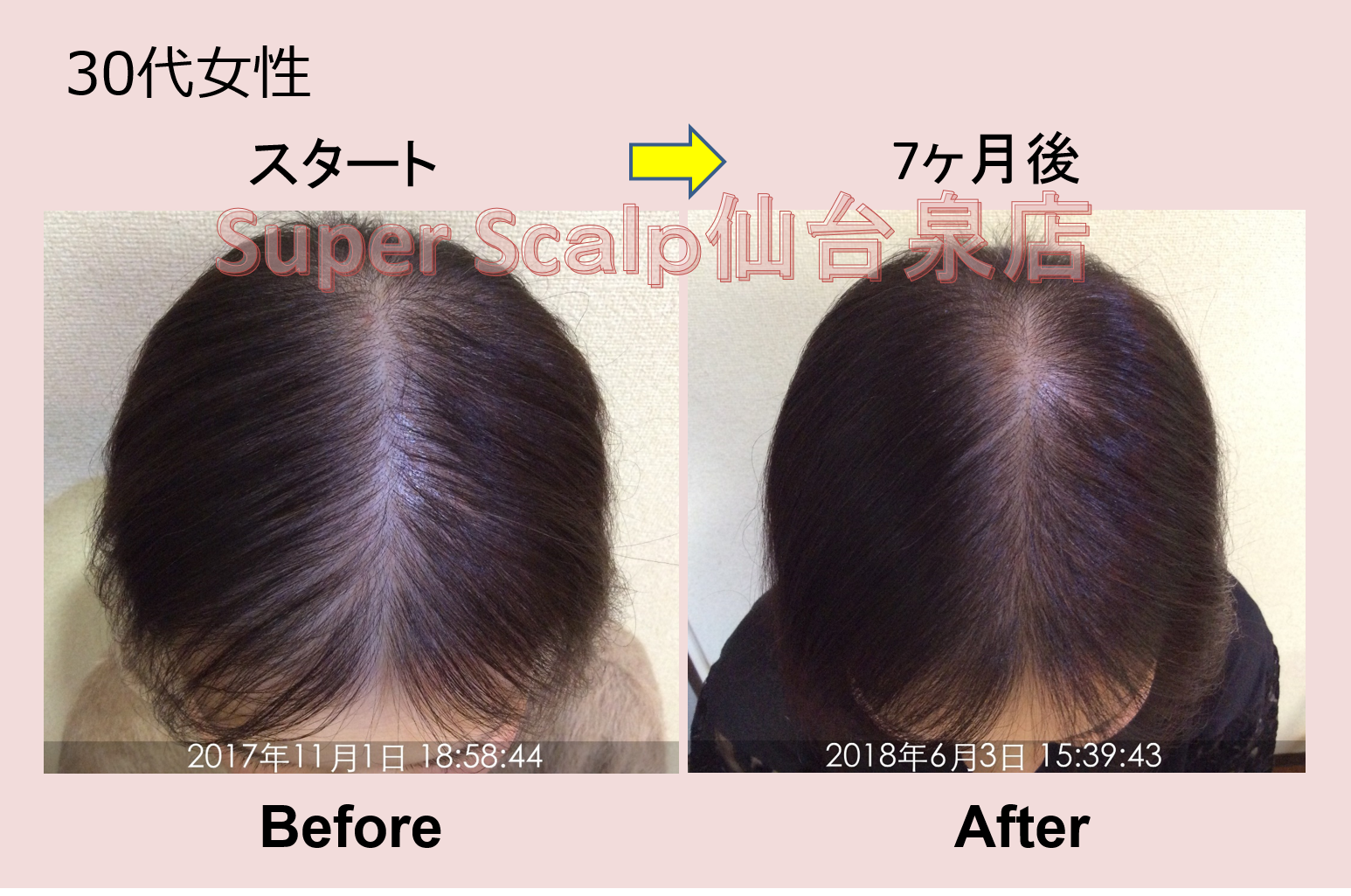 重度のびまん性脱毛症が7カ月で改善。30代女性の発毛症例をご紹介します。 仙台で薄毛AGA対策！女性男性の薄毛、AGA改善発毛98.7