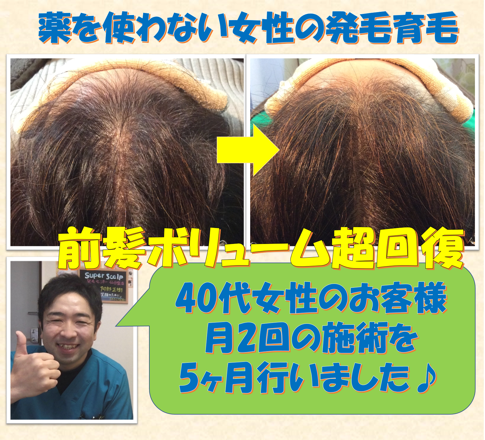 【発毛症例】40代女性の前髪のボリュームがアップ！！その施術のペースと回数は！？