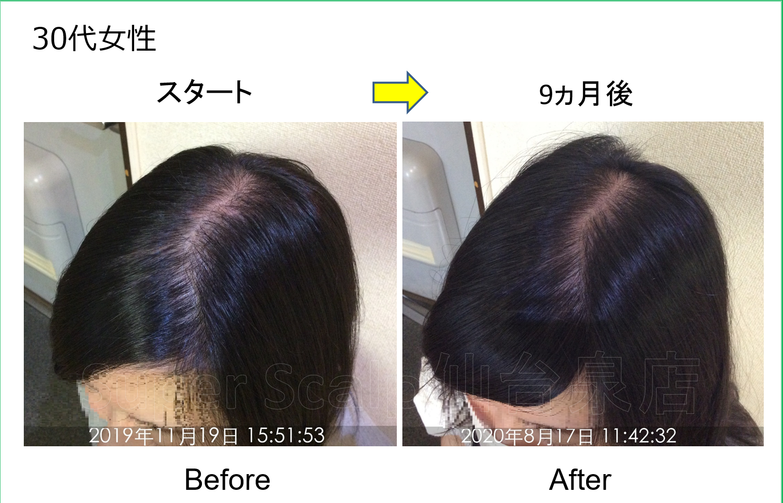 32歳女性のびまん性脱毛症が改善♪仙台で女性の薄毛治療は当店にお任せください。