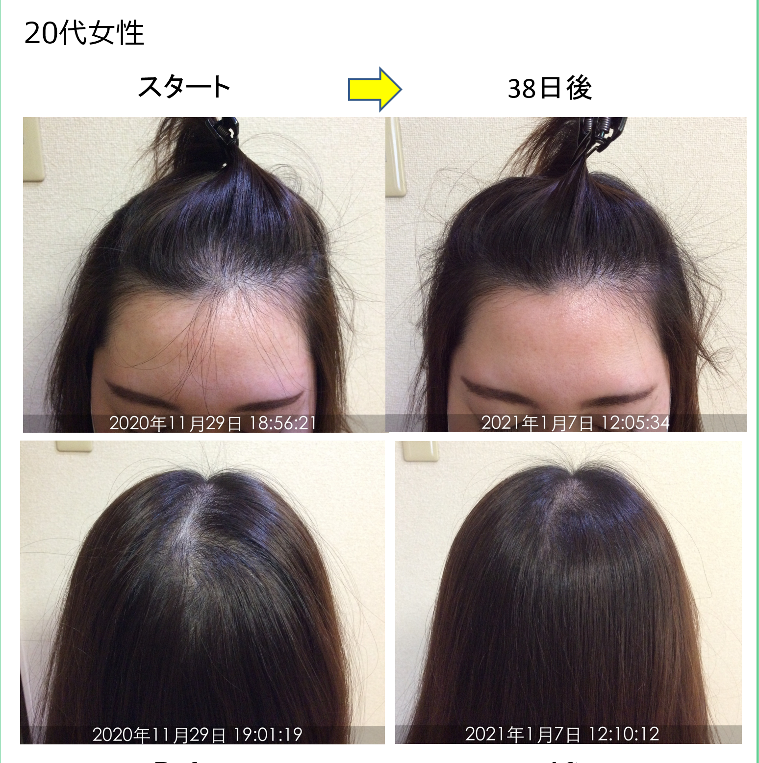 【20代女性発毛症例】青森県から月2回ご来店♪1ヶ月半で効果を実感♪