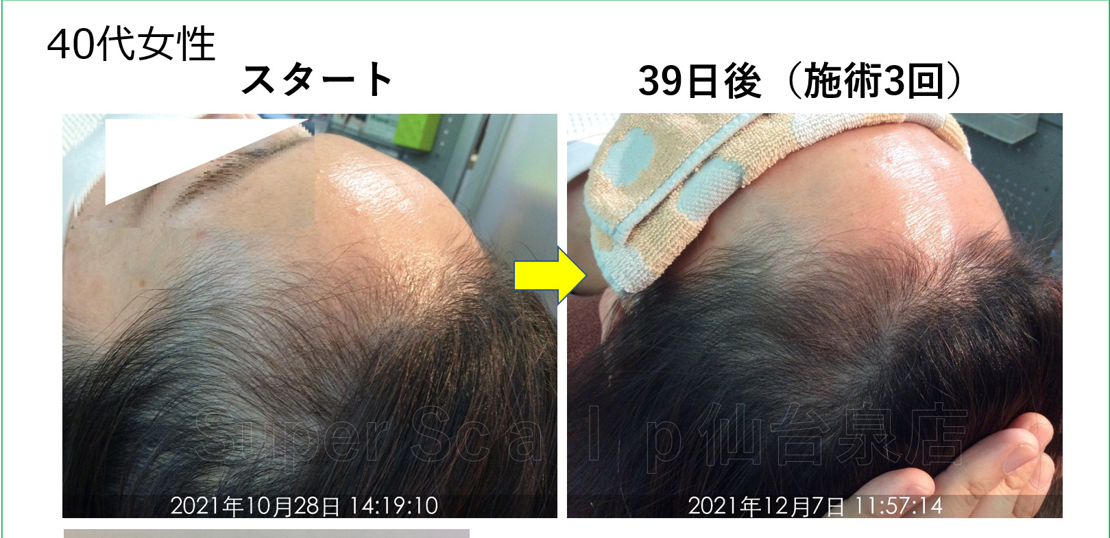 【40代女性発毛症例】施術3回で生え際Ⅿ字の薄毛改善「安心して任せられます」