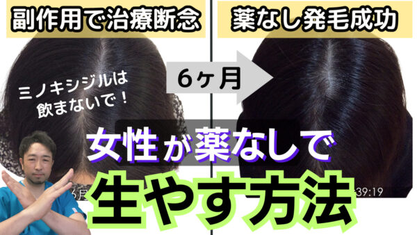 【仙台で女性の薄毛治療】ミノキシジルの副作用を知らずに飲んで悩む女性が仙台で急増しています。体毛増加、初期脱毛、動悸など解説します。