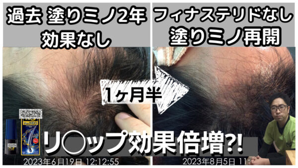 塗りミノ（ミノキシジル外用薬）の効果がない理由と薄毛改善の対策を解説します。