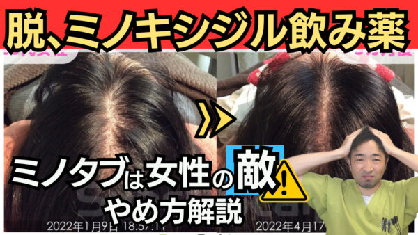 【発毛症例解説】女性がミノキシジル内服薬をやめて発毛する方法