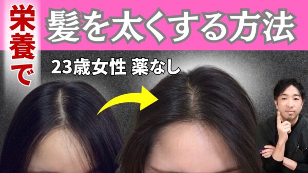 【栄養で発毛促進】23歳女性の薄毛の根本原因と”薬なし”で発毛した方法