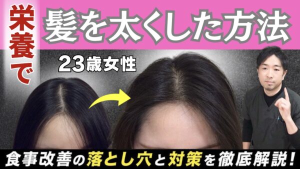 【ミノキシジルなし】23歳女性の薄毛の根本原因と”薬なし”で発毛した方法