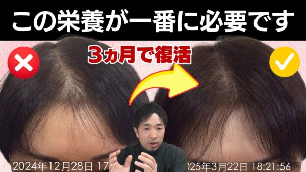 【30代女性発毛症例】前髪が薄くなる本当の原因は「糖質不足」だった？論文が示す髪のエネルギー不足