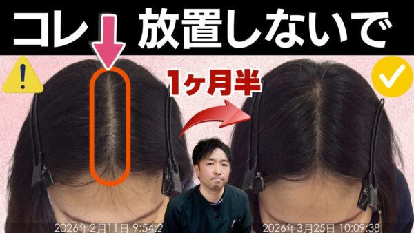 【早期対策】女性の薄毛3つのサインと対策【41歳女性発毛ビフォーアフター】