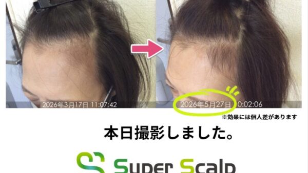【本日撮影】薬なしで60歳女性お客様のM字がグングン発毛！施術6回2ヶ月の変化