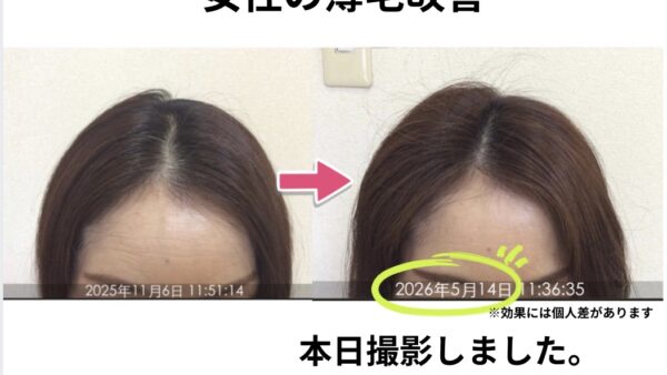 【本日撮影】48歳女性の生え際の薄毛が改善「髪がペタンとして来たら…」髪が細くなっているサインです。