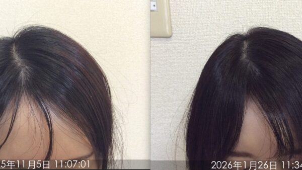 【本日撮影】ミノキシジルなし！46歳女性の薄毛改善ビフォーアフターをご紹介します。