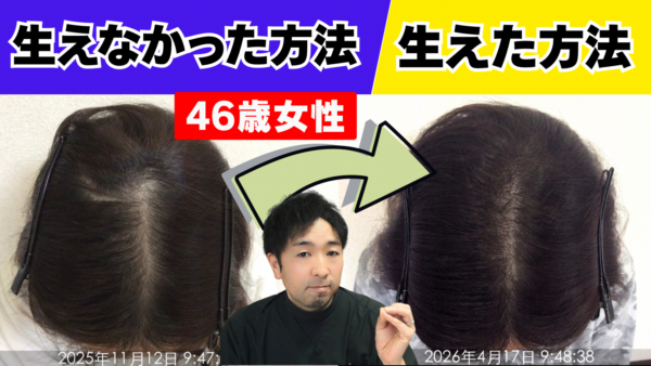 【女性は要注意】ミノキシジルの初期脱毛とは？46歳女性が薬を使わず髪のボリュームを改善した方法【女性の薄毛改善症例】